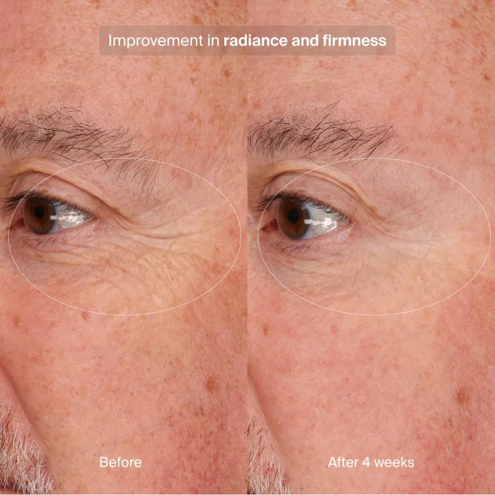 Precision Eye Lift
