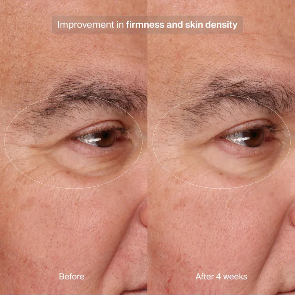 Precision Eye Lift